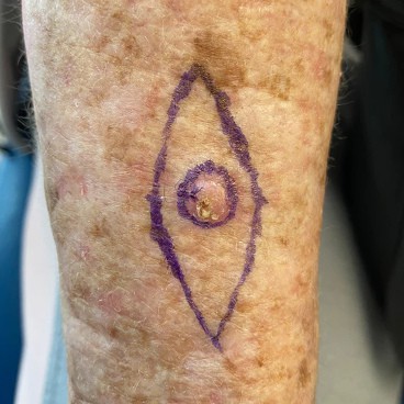 Lesion on arm,Sovereign Medical